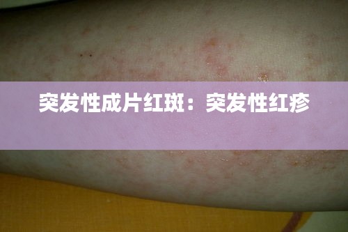突发性成片红斑：突发性红疹 